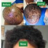Before and after using Liora Organics hair oil for bald spots and alopecia