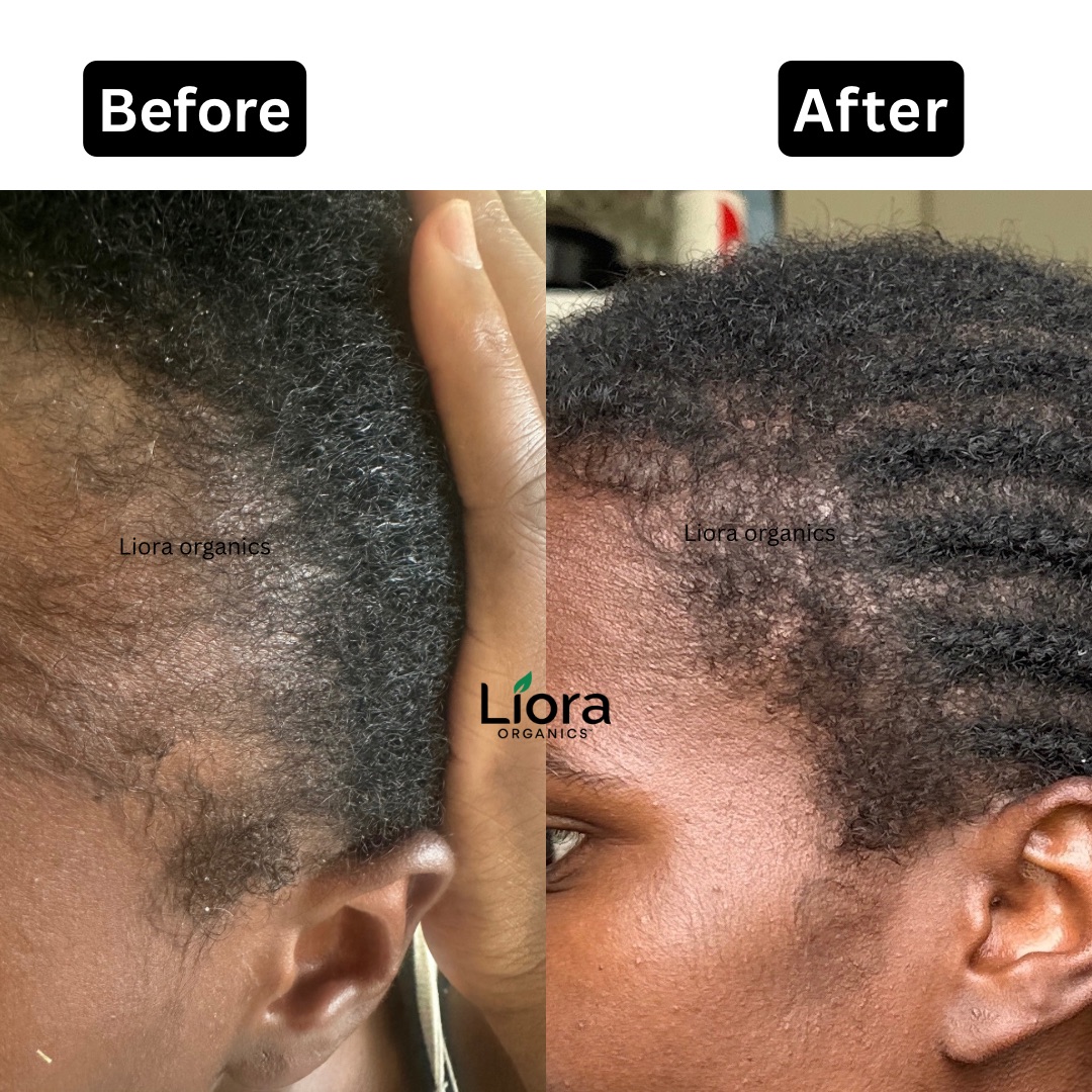 Hair line hair growth oil for hairline and edges.